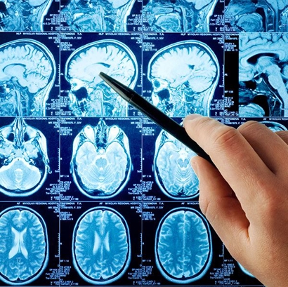 Traumatic Brain Injury Image